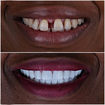 Slider image (4) Uzmanlar Dental Clinic